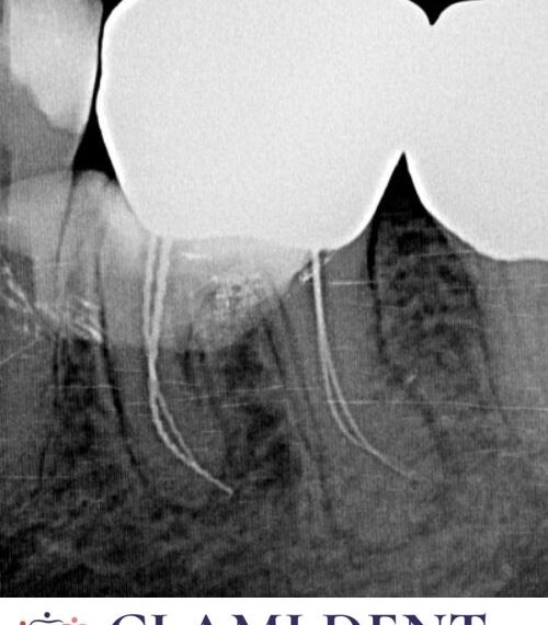 Succesul Tratamentului de Canal Alba Iulia