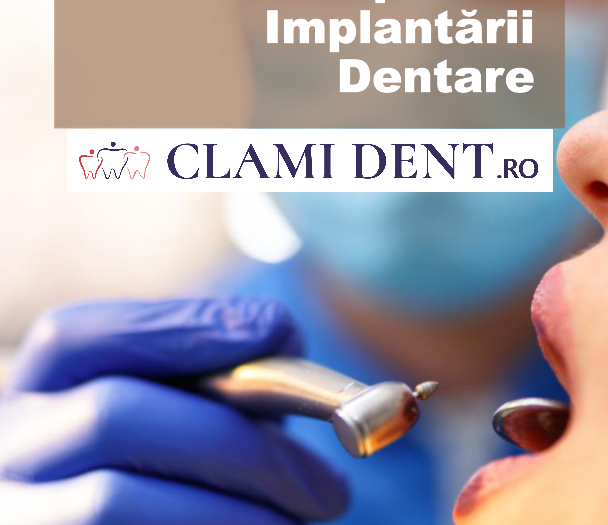 Când a apărut tehnica de implantare dentară? Ghid complet de la Clami Dent, Alba Iulia