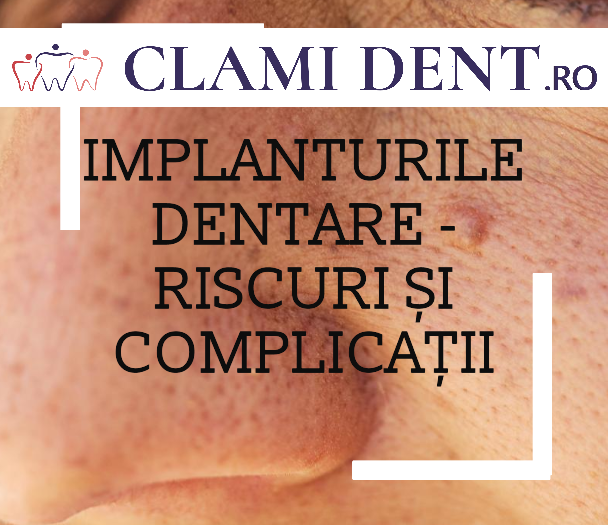 Care sunt riscurile și complicațiile asociate cu implanturile dentare?