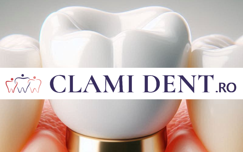 Implant Dentar vs. Proteză Care Este Alegerea Corectă