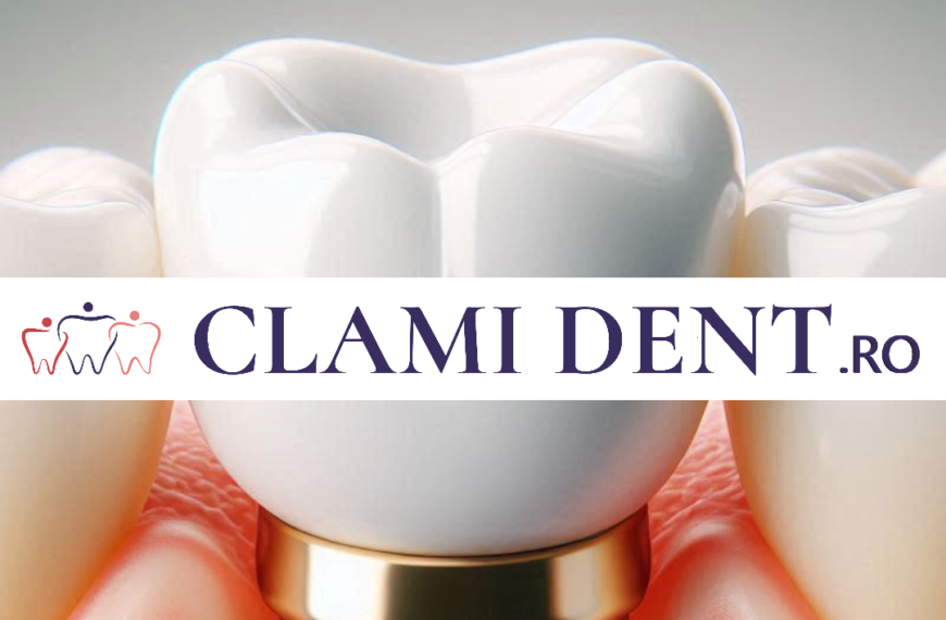Implant Dentar vs. Proteză Care Este Alegerea Corectă