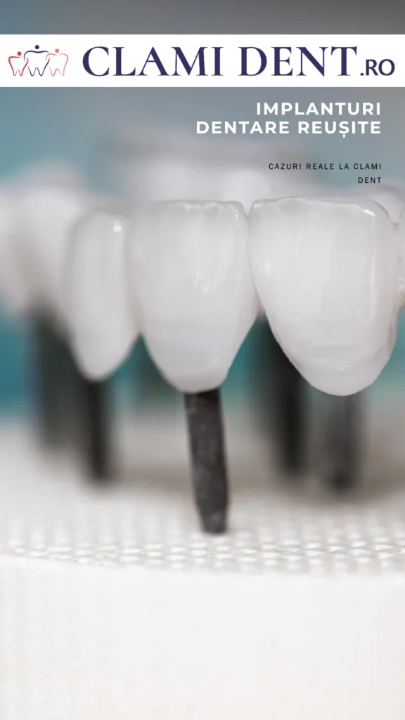Clami Dent Alba Iulia – Expertiză în Implanturi Dentare