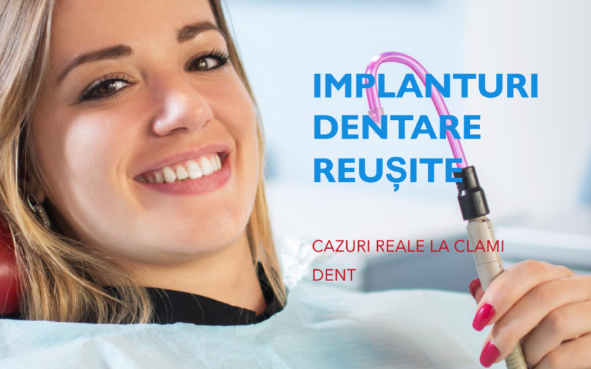 Implanturi Dentare Reușite la Clami Dent Alba Iulia – Cazuri Reale