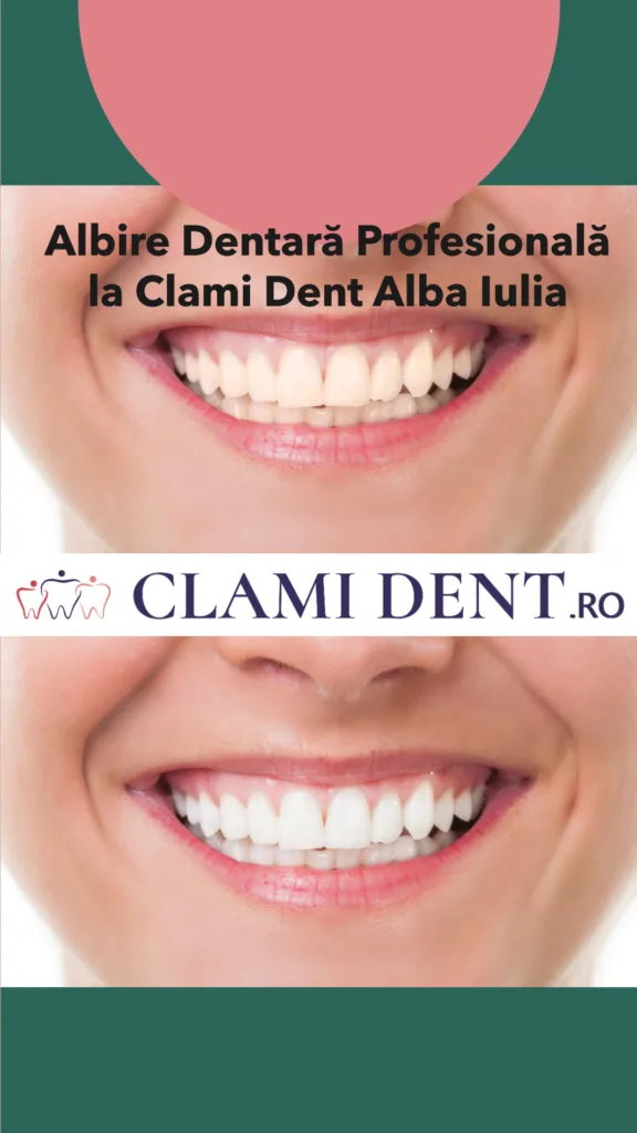 Albire Dentară Profesională la Clami Dent Alba Iulia
