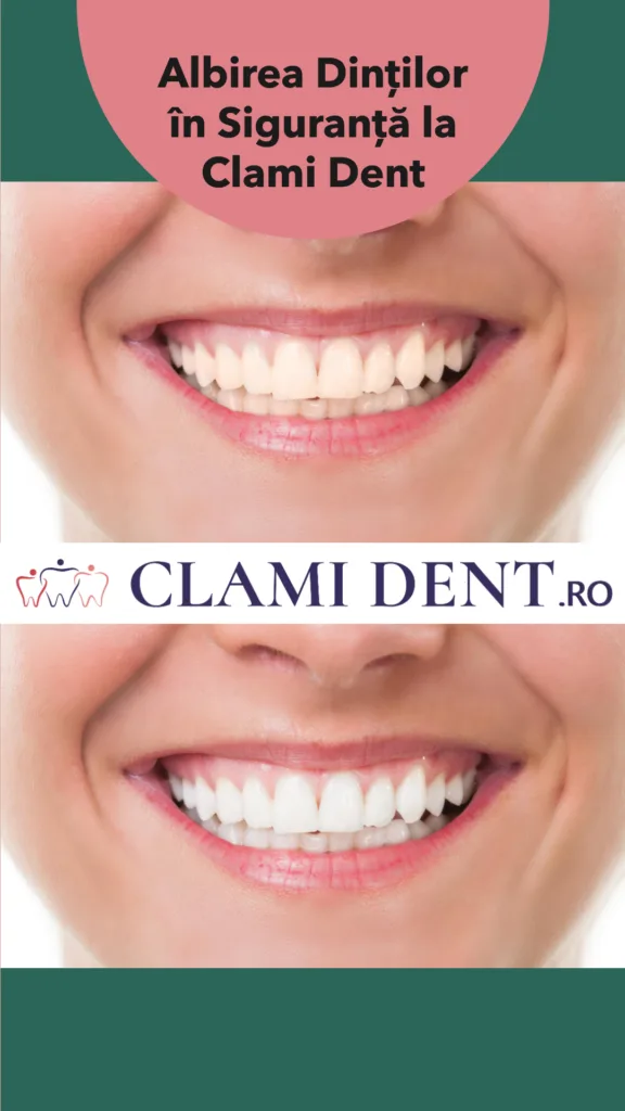 Albirea Dinților în Siguranță la Clami Dent