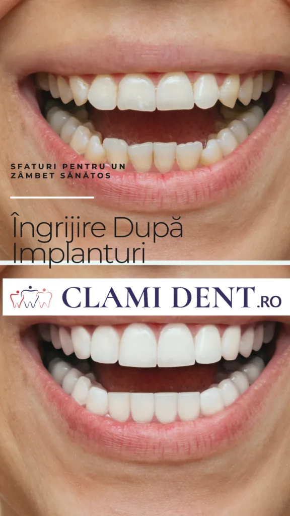 Implanturi Dentare Sfaturi pentru Menținerea Zâmbetului După Tratament