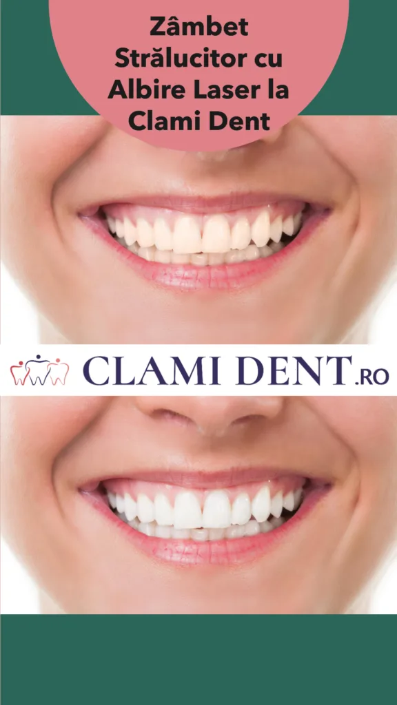 Zâmbet Strălucitor cu Albire Laser la Clami Dent