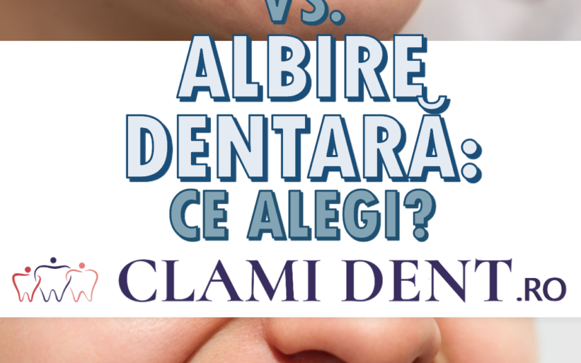 Fațete vs. albire dentară ce alegi