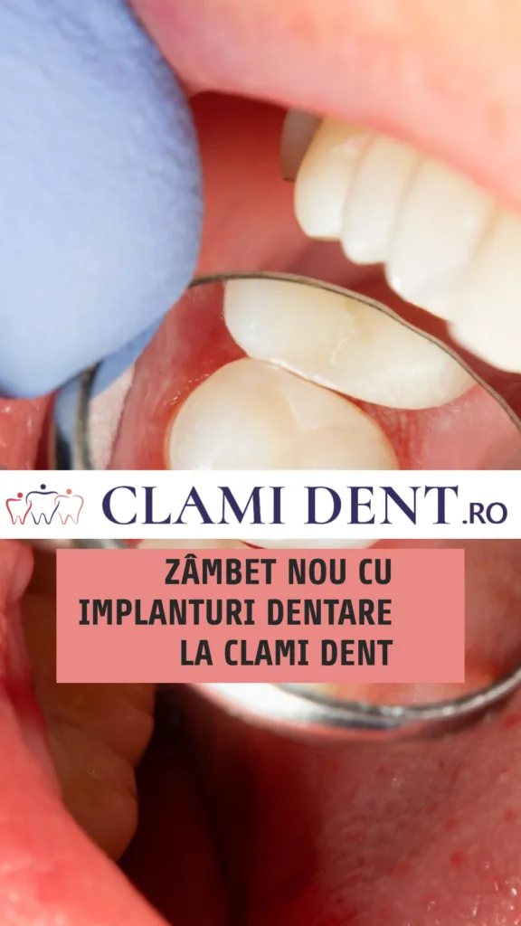 Zâmbet nou cu implanturi dentare la Clami Dent