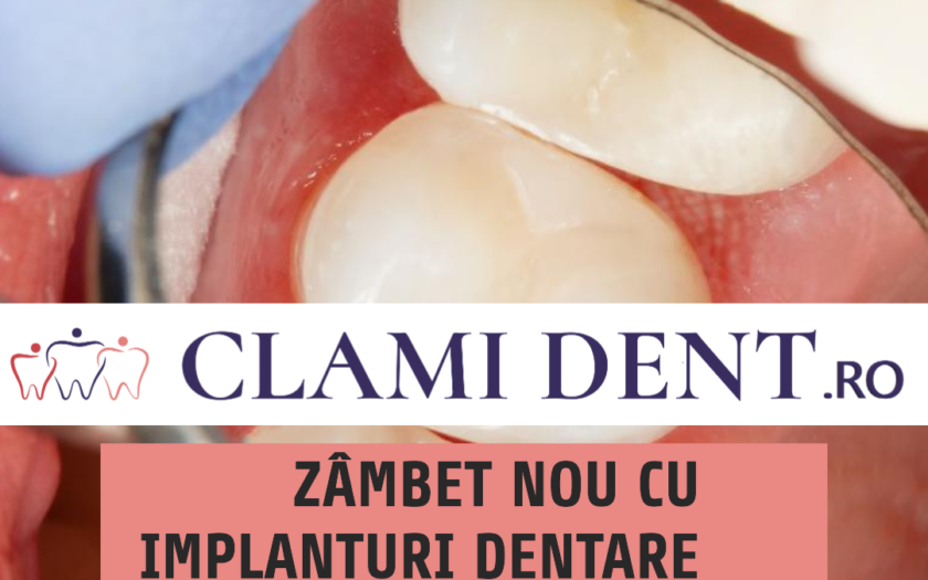 Zâmbet nou cu implanturi dentare la Clami Dent