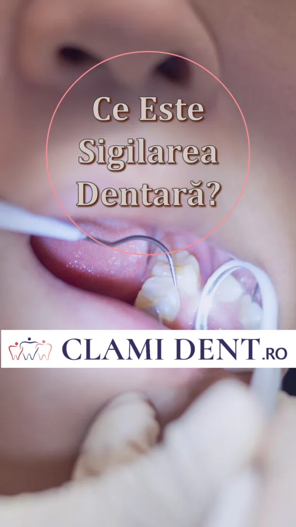 Ce este sigilarea dentară și când se recomandă Alba Iulia