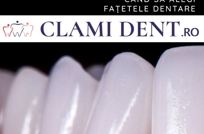 Fațete dentare când sunt recomandate Clami Dent Alba Iulia