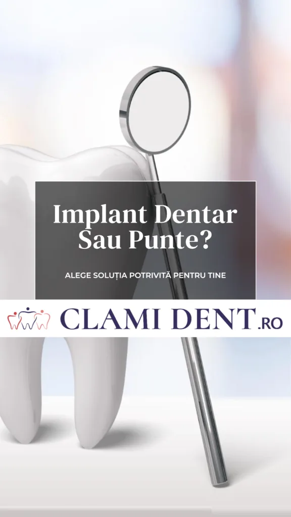 Implant dentar sau punte Ce să alegi