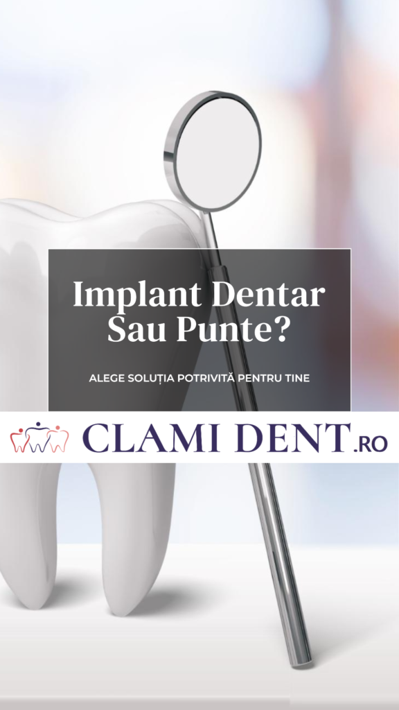 Implant dentar sau punte Ce să alegi