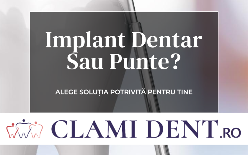 Implant dentar sau punte Ce să alegi