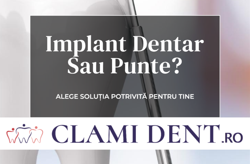 Implant dentar sau punte Ce să alegi