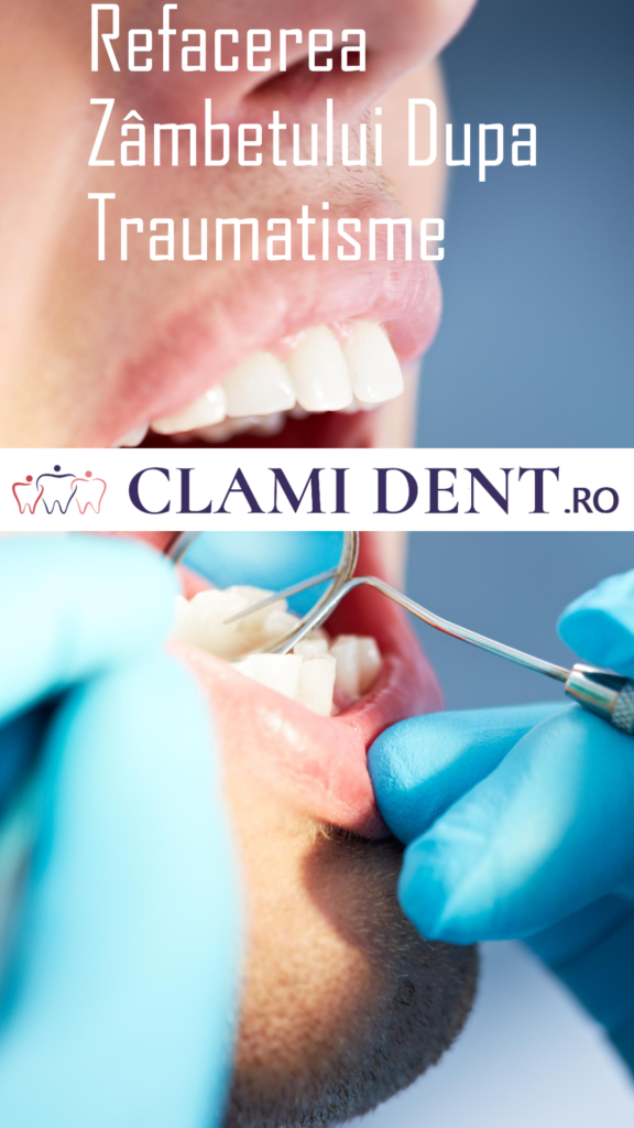Refacerea zâmbetului după traumatisme dentare alba iulia
