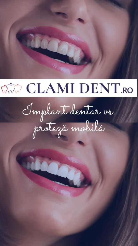 Implant dentar vs. proteză mobilă alba iulia