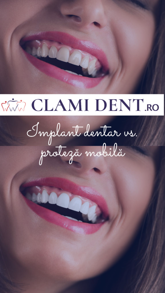 Implant dentar vs. proteză mobilă alba iulia