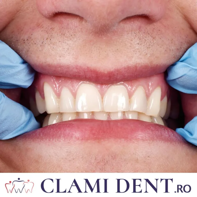 0 Albire dentară Alba Iulia Implanturi Dentare Dentist